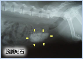 膀胱結石