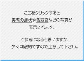 緑内障