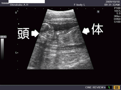 妊娠6週写真